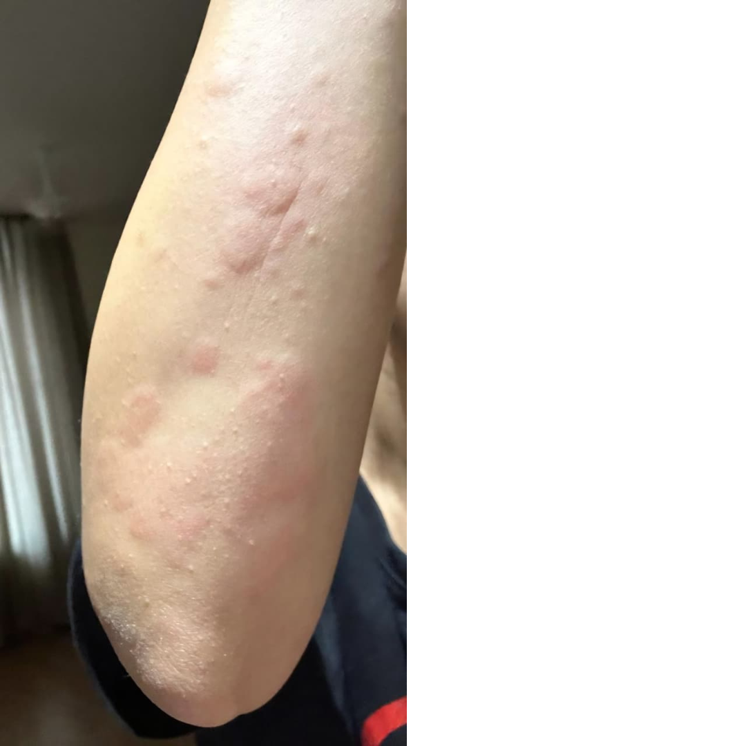 endometriosis, cyst, before image, one program, nutrition in sync, skin flare ups