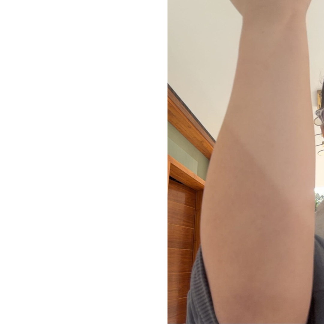endometriosis, cyst, after image, one program, nutrition in sync, skin flare ups