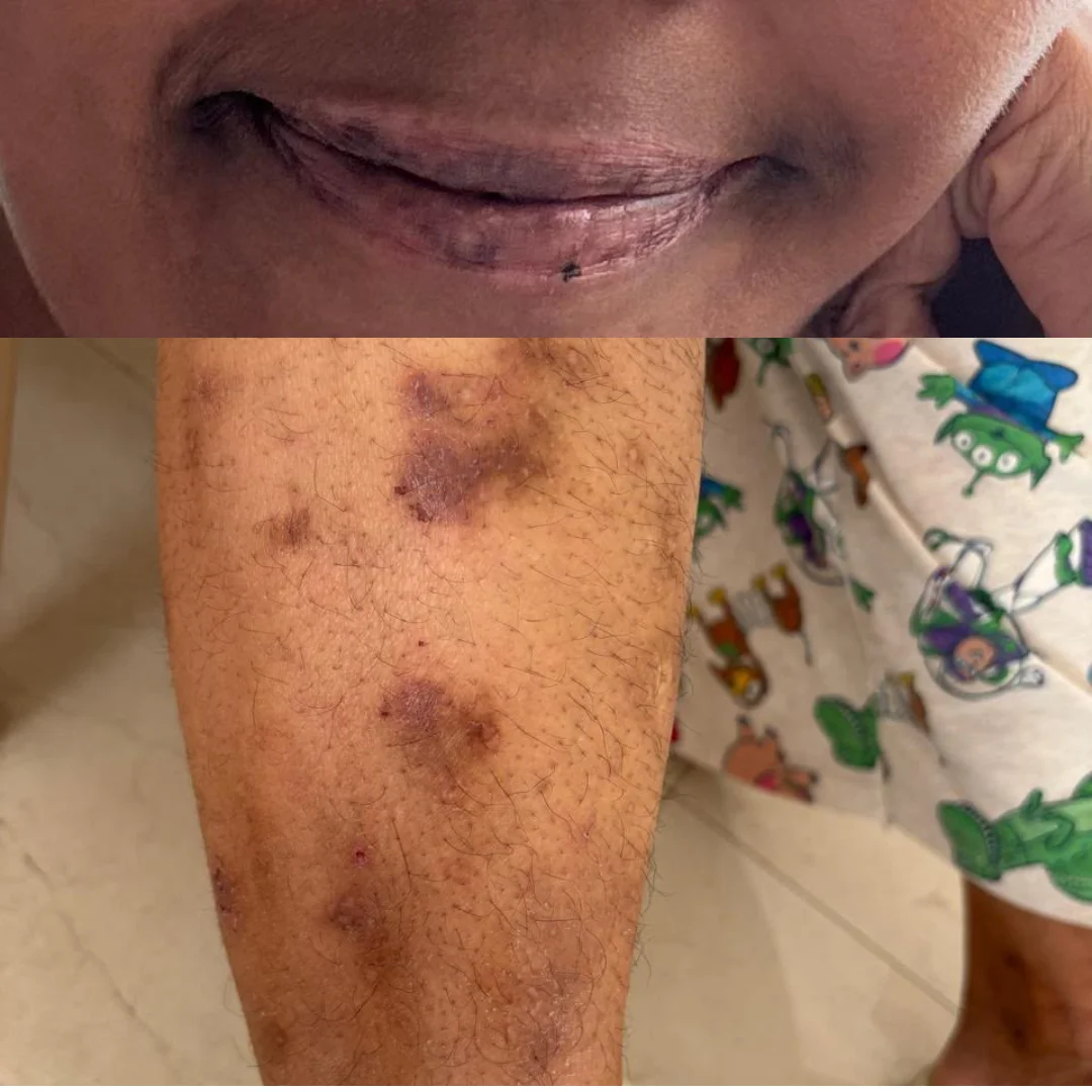 client suffering from eczema, hashimotos