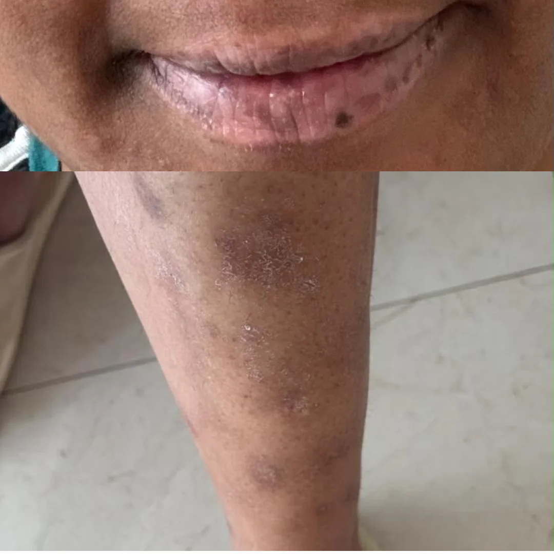 Client recovered from skin issues after One Program