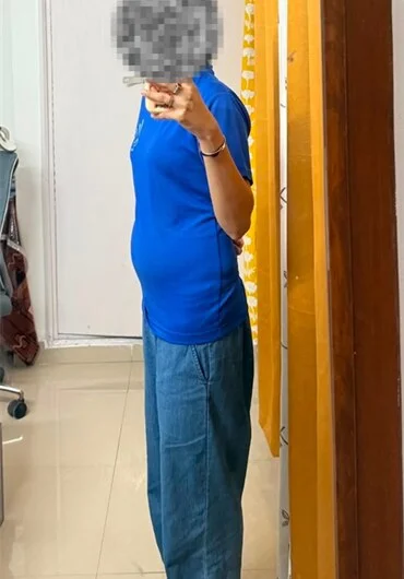 Community Gut Cleanse client before the programme, abdominal bloating