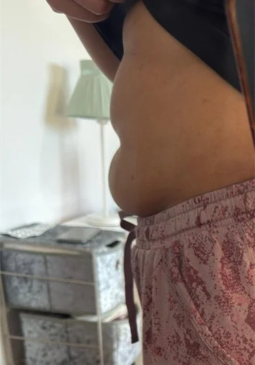 Community Gut Cleanse client before the programme, abdominal bloating